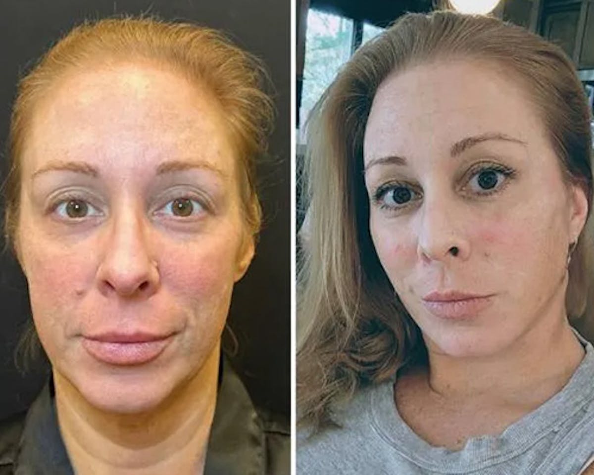 Deep Plane Facelift Before & After Gallery - Patient 199709 - Image 2