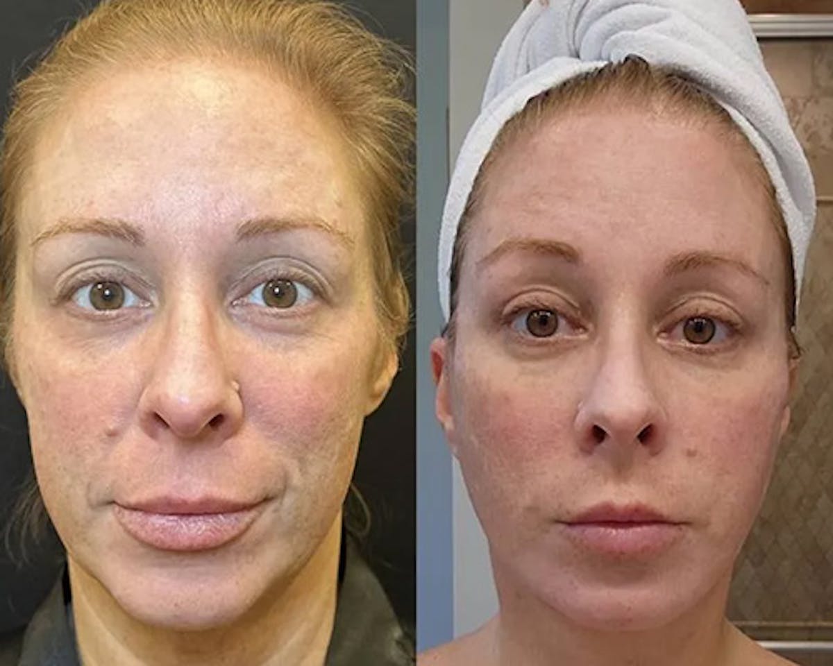 Deep Plane Facelift Before & After Gallery - Patient 199709 - Image 3