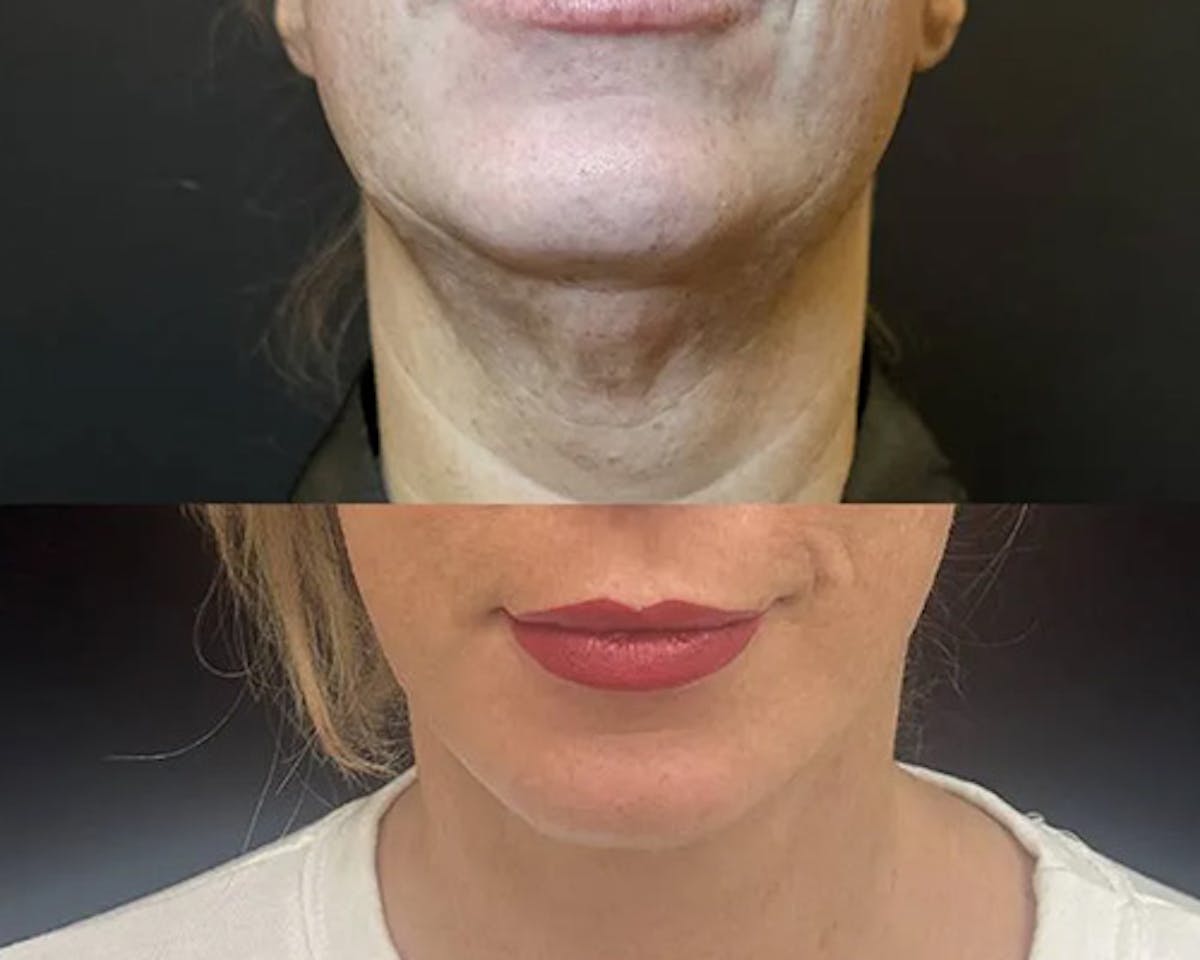 Deep Plane Facelift Before & After Gallery - Patient 199709 - Image 4