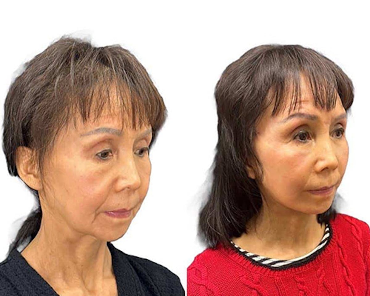 Ethnic Facelift Before & After Gallery - Patient 426793 - Image 1