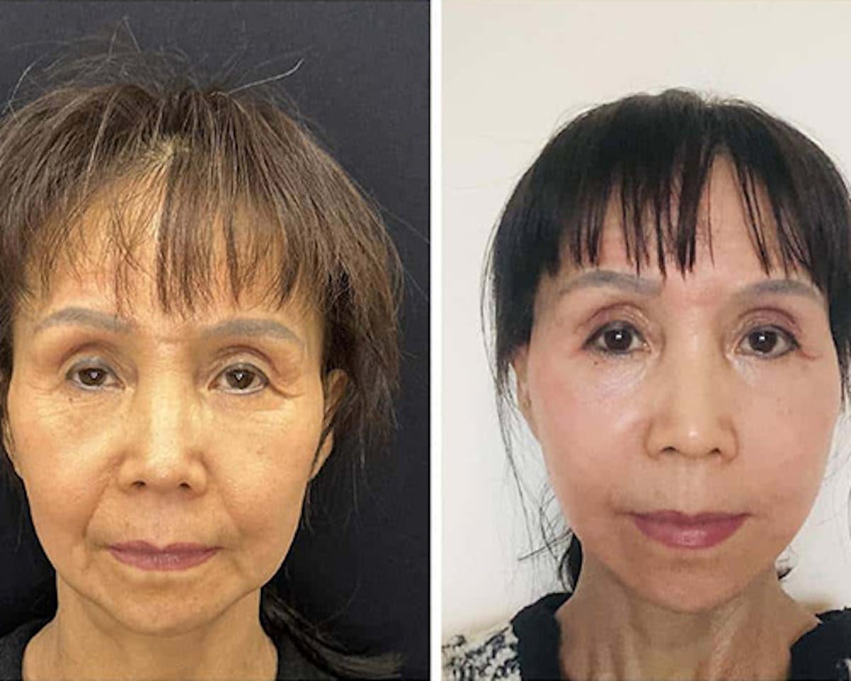 Ethnic Facelift Before & After Gallery - Patient 426793 - Image 2