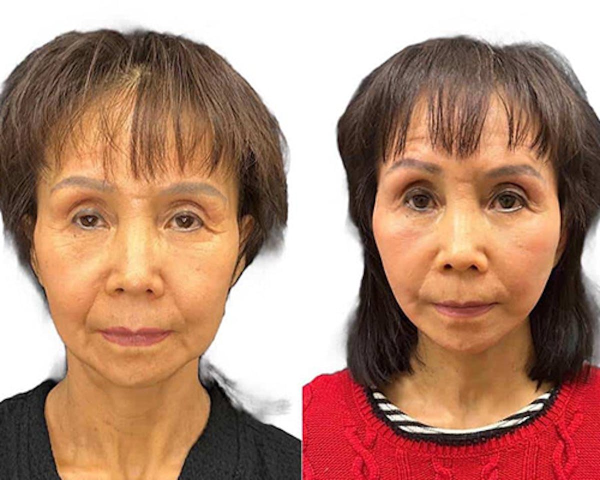 Ethnic Facelift Before & After Gallery - Patient 426793 - Image 3