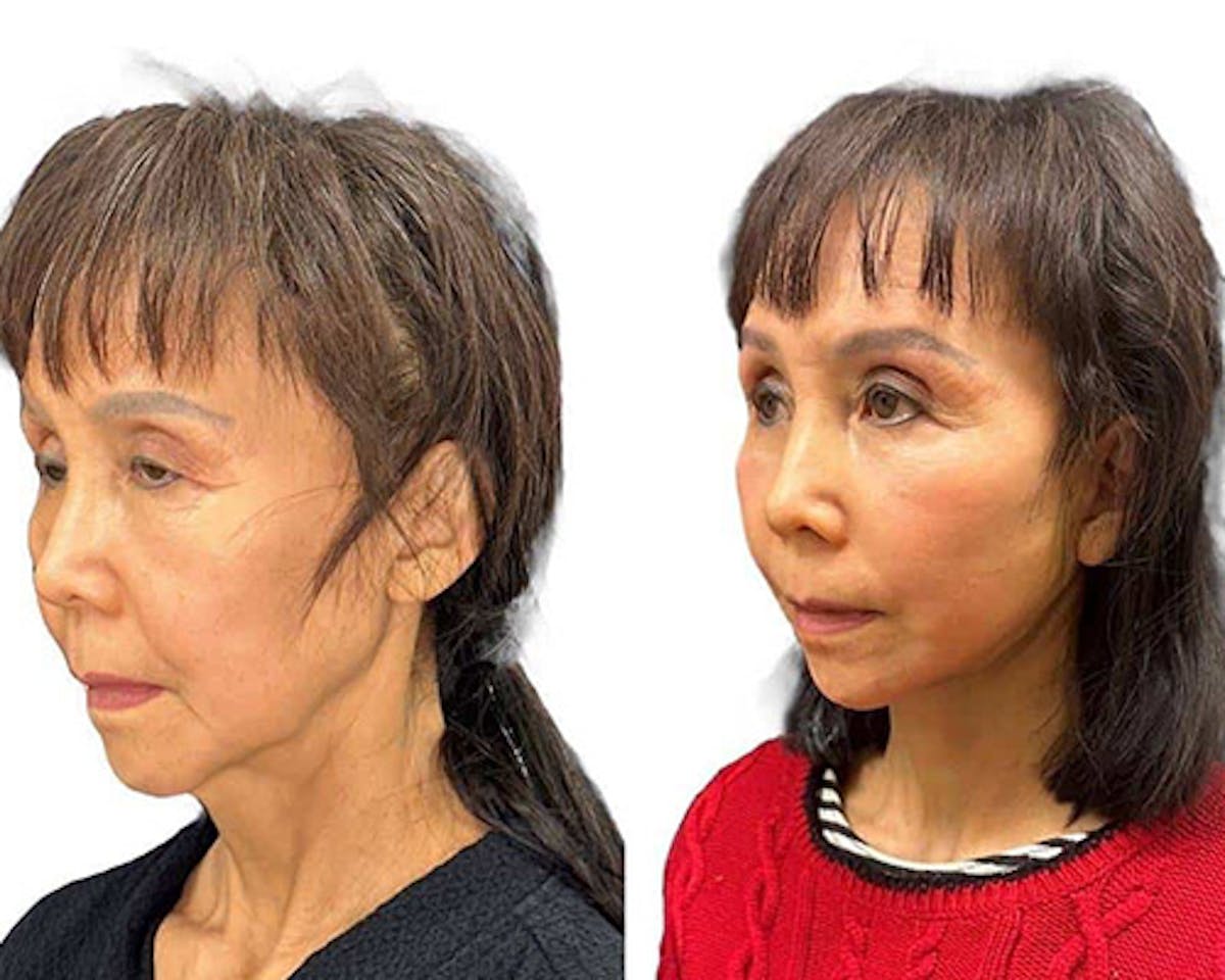 Ethnic Facelift Before & After Gallery - Patient 426793 - Image 4