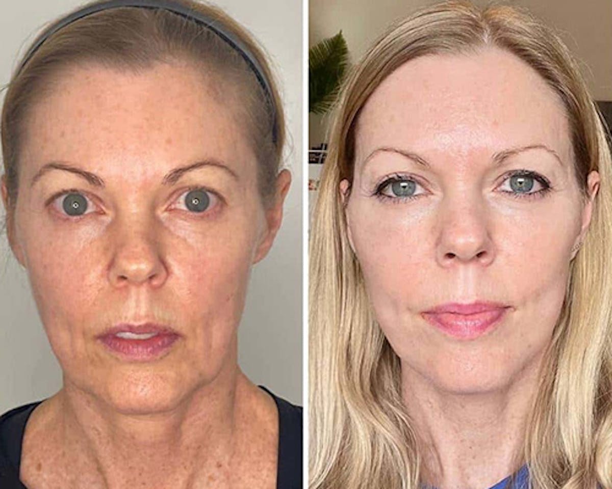 Deep Plane Facelift Before & After Gallery - Patient 124837 - Image 1