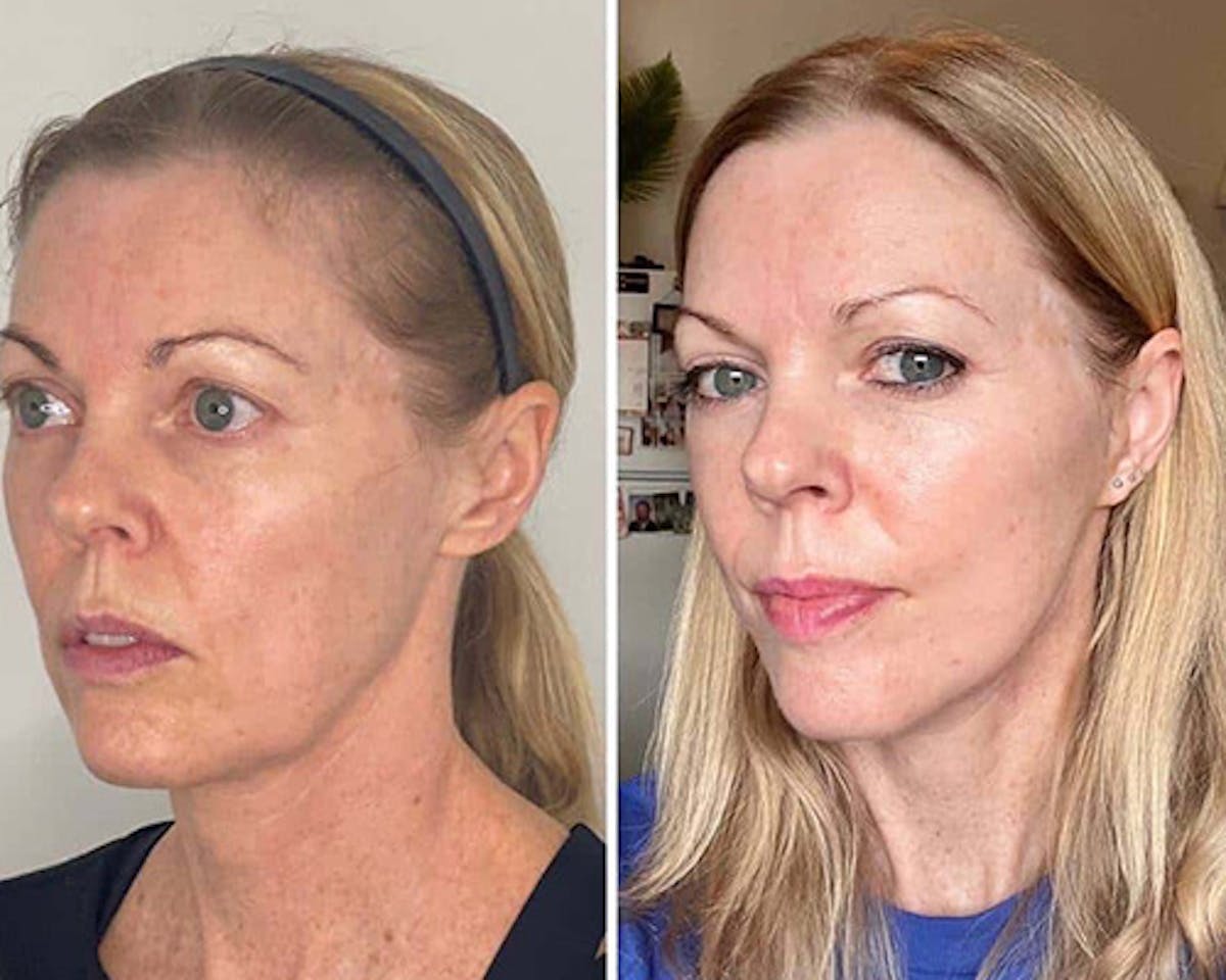 Deep Plane Facelift Before & After Gallery - Patient 124837 - Image 2
