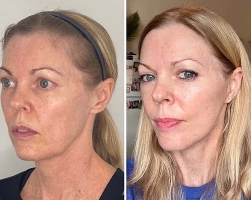 Deep Plane Facelift Before & After Gallery - Patient 124837 - Image 2