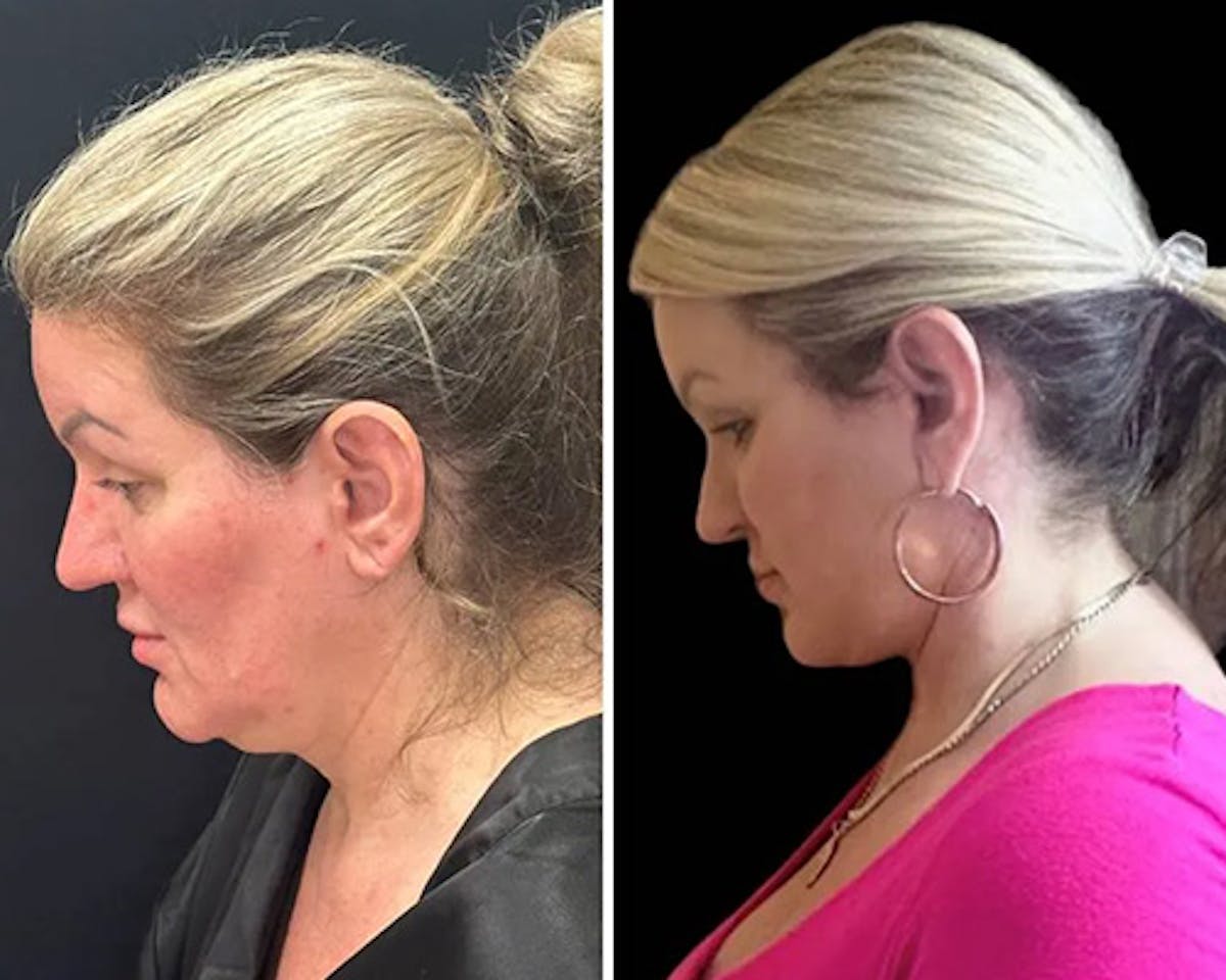 Deep Plane Facelift Before & After Gallery - Patient 155681 - Image 1