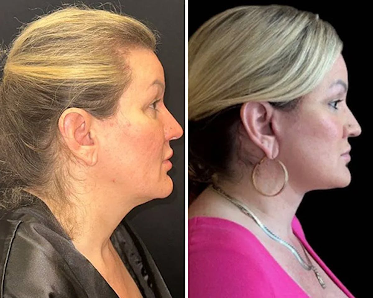 Deep Plane Facelift Before & After Gallery - Patient 155681 - Image 2