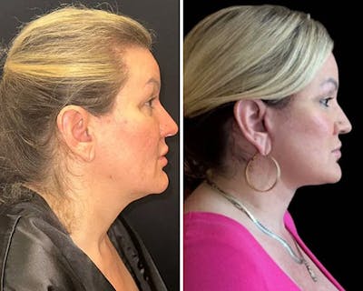 Deep Plane Facelift Before & After Gallery - Patient 155681 - Image 2
