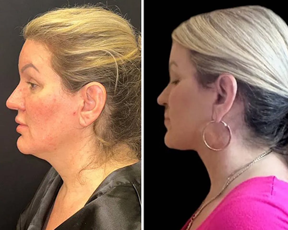 Deep Plane Facelift Before & After Gallery - Patient 155681 - Image 3