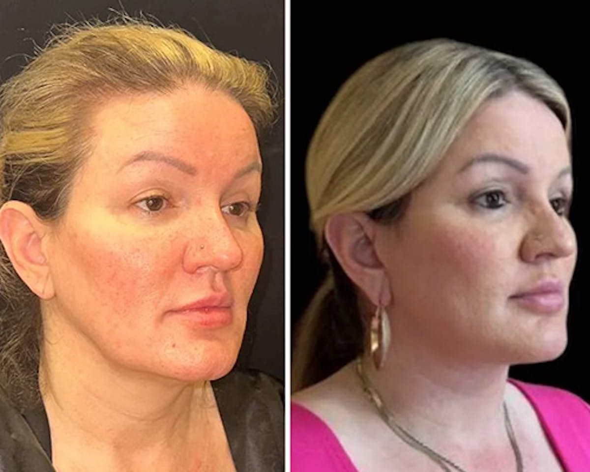 Deep Plane Facelift Before & After Gallery - Patient 155681 - Image 4