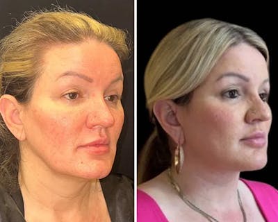 Deep Plane Facelift Before & After Gallery - Patient 155681 - Image 4