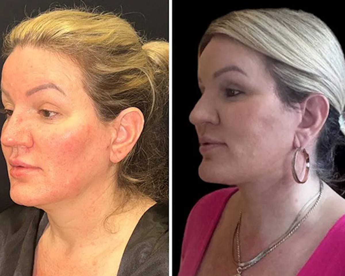 Deep Plane Facelift Before & After Gallery - Patient 155681 - Image 5