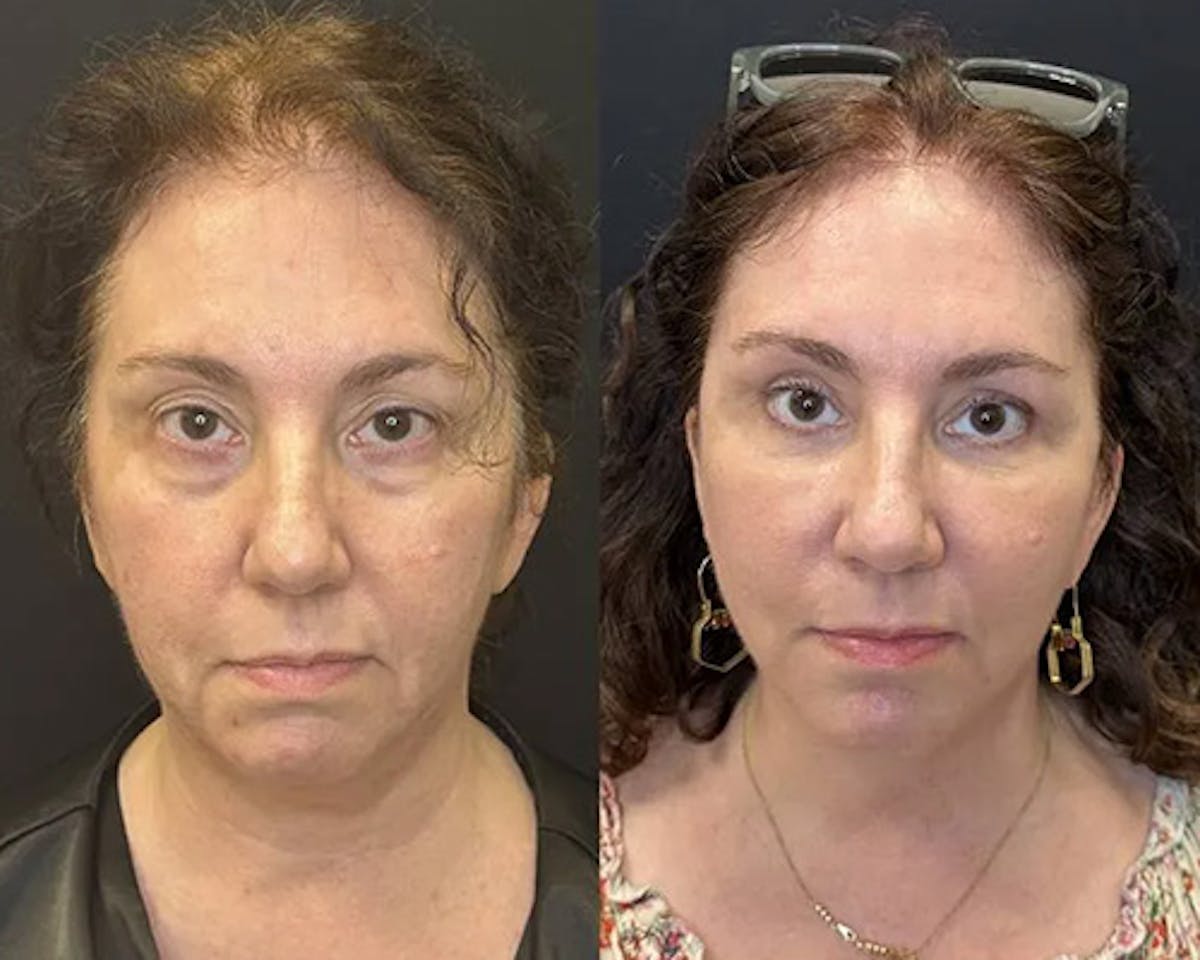 Deep Plane Facelift Before & After Gallery - Patient 304945 - Image 1