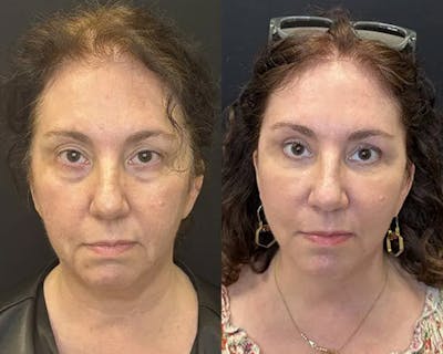 Deep Plane Facelift Before & After Gallery - Patient 304945 - Image 1
