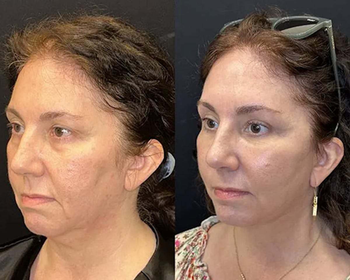 Deep Plane Facelift Before & After Gallery - Patient 304945 - Image 2