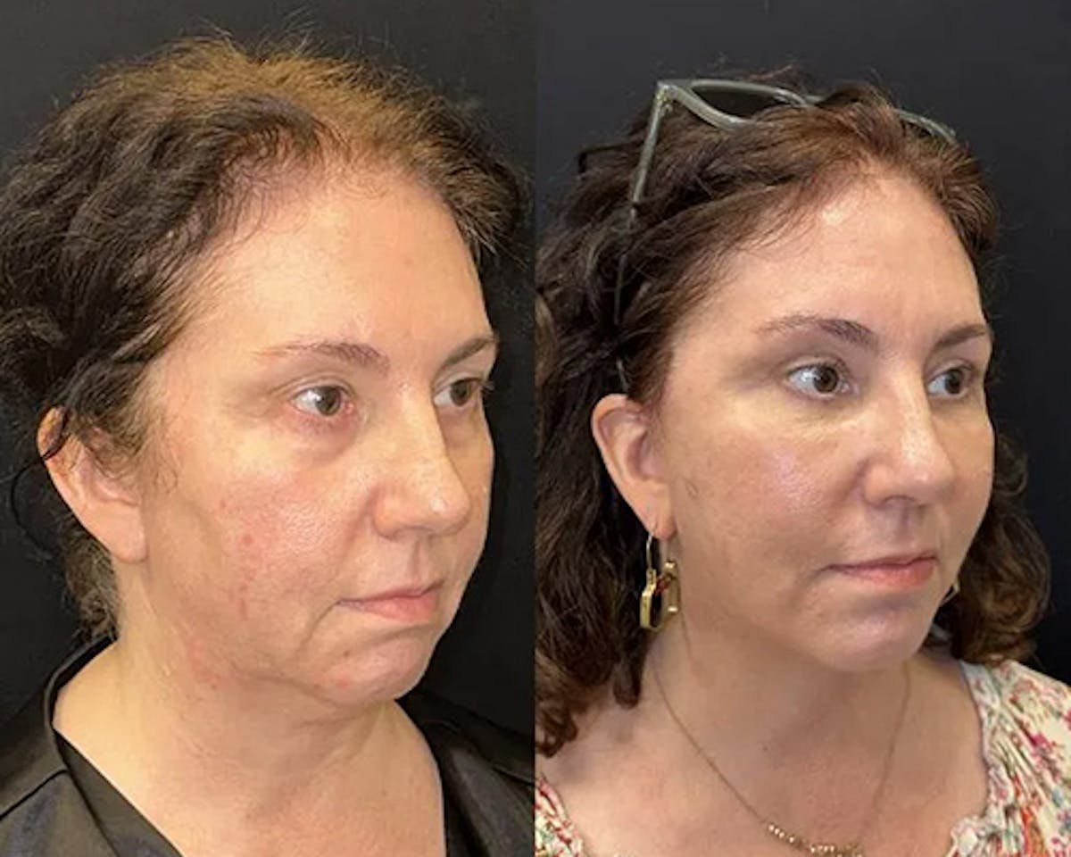 Deep Plane Facelift Before & After Gallery - Patient 304945 - Image 3