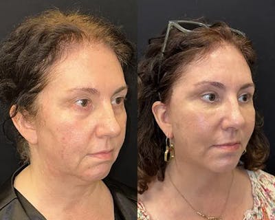 Deep Plane Facelift Before & After Gallery - Patient 304945 - Image 3