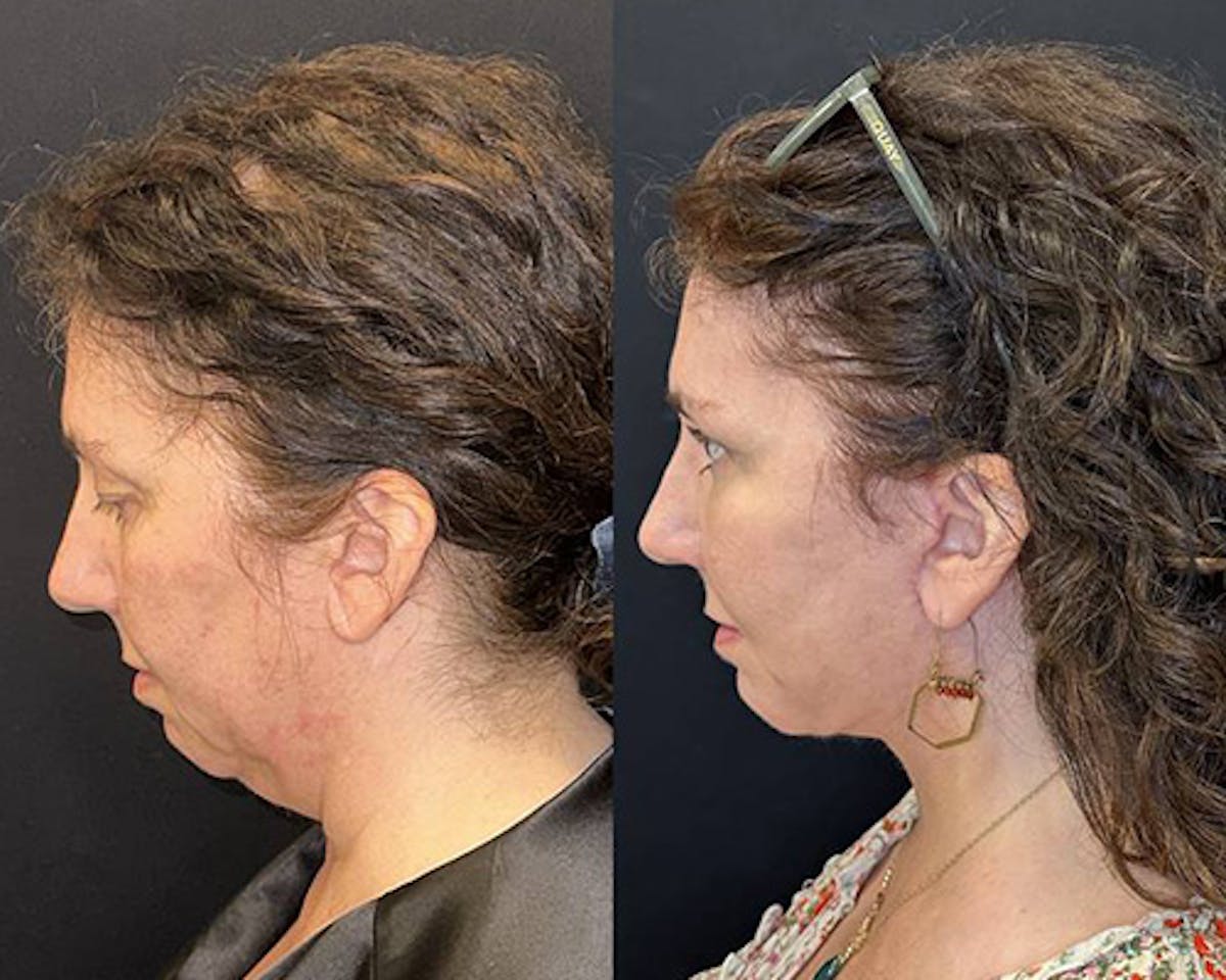 Deep Plane Facelift Before & After Gallery - Patient 304945 - Image 4