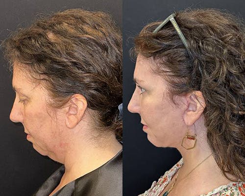 Deep Plane Facelift Before & After Gallery - Patient 304945 - Image 4