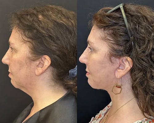Deep Plane Facelift Before & After Gallery - Patient 304945 - Image 5
