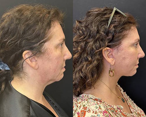 Deep Plane Facelift Before & After Gallery - Patient 304945 - Image 6