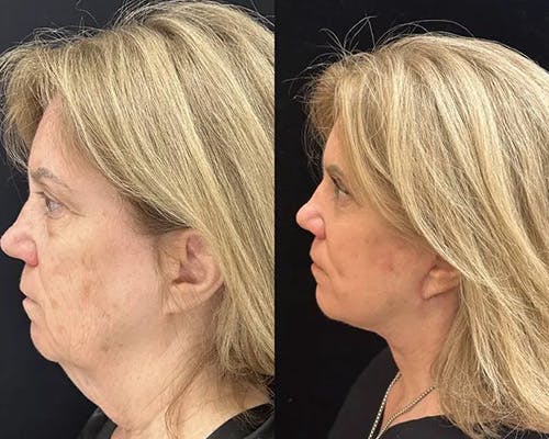 Deep Plane Facelift Before & After Gallery - Patient 404403 - Image 1