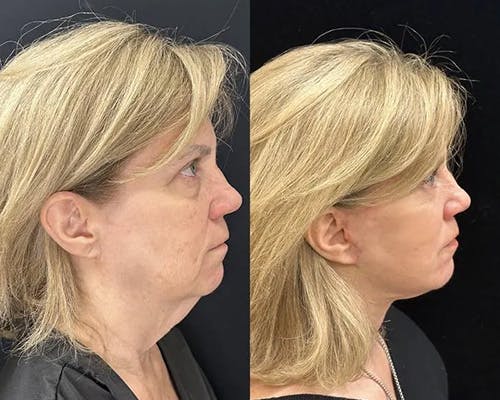 Deep Plane Facelift Before & After Gallery - Patient 404403 - Image 2