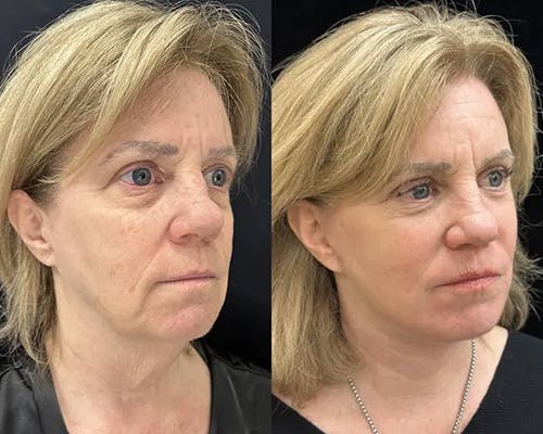 Deep Plane Facelift Before & After Gallery - Patient 404403 - Image 3