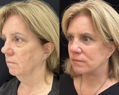 Deep Plane Facelift Before & After Gallery - Patient 404403 - Image 4