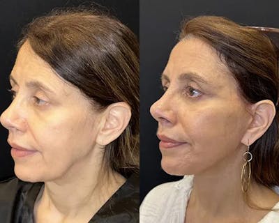 Deep Plane Facelift Before & After Gallery - Patient 191723 - Image 1
