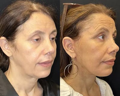 Deep Plane Facelift Before & After Gallery - Patient 191723 - Image 2