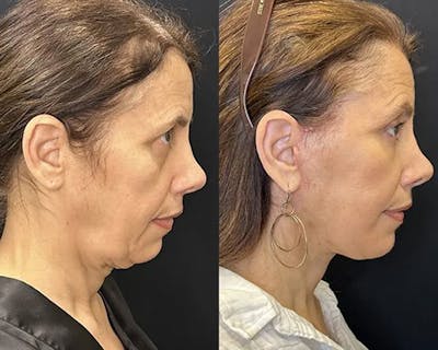 Deep Plane Facelift Before & After Gallery - Patient 191723 - Image 3