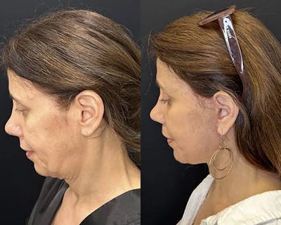Deep Plane Facelift Before & After Gallery - Patient 191723 - Image 4