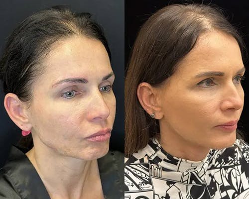 Deep Plane Facelift Before & After Gallery - Patient 236788 - Image 1