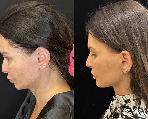 Deep Plane Facelift Before & After Gallery - Patient 236788 - Image 2