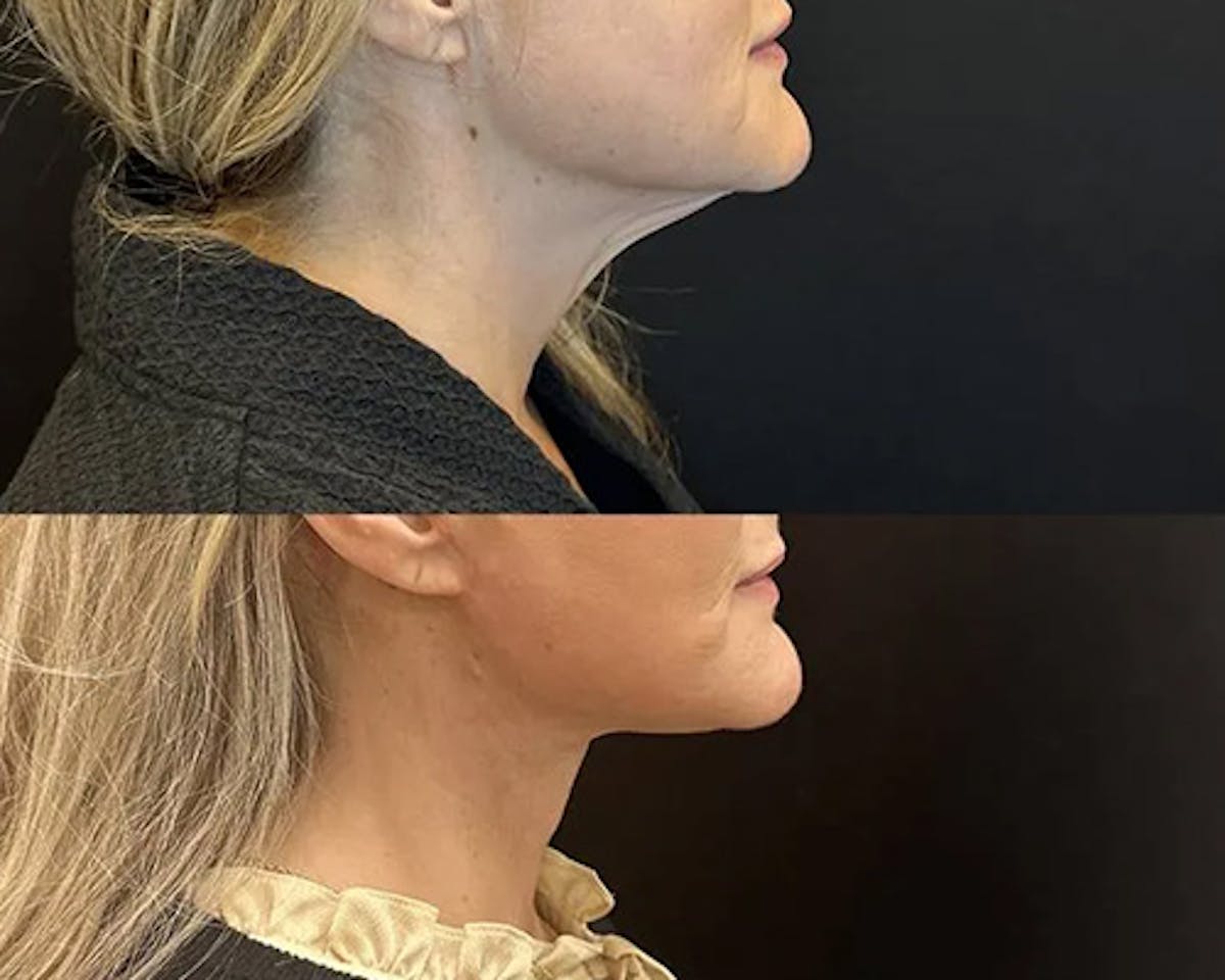 Deep Plane Facelift Before & After Gallery - Patient 689523 - Image 1