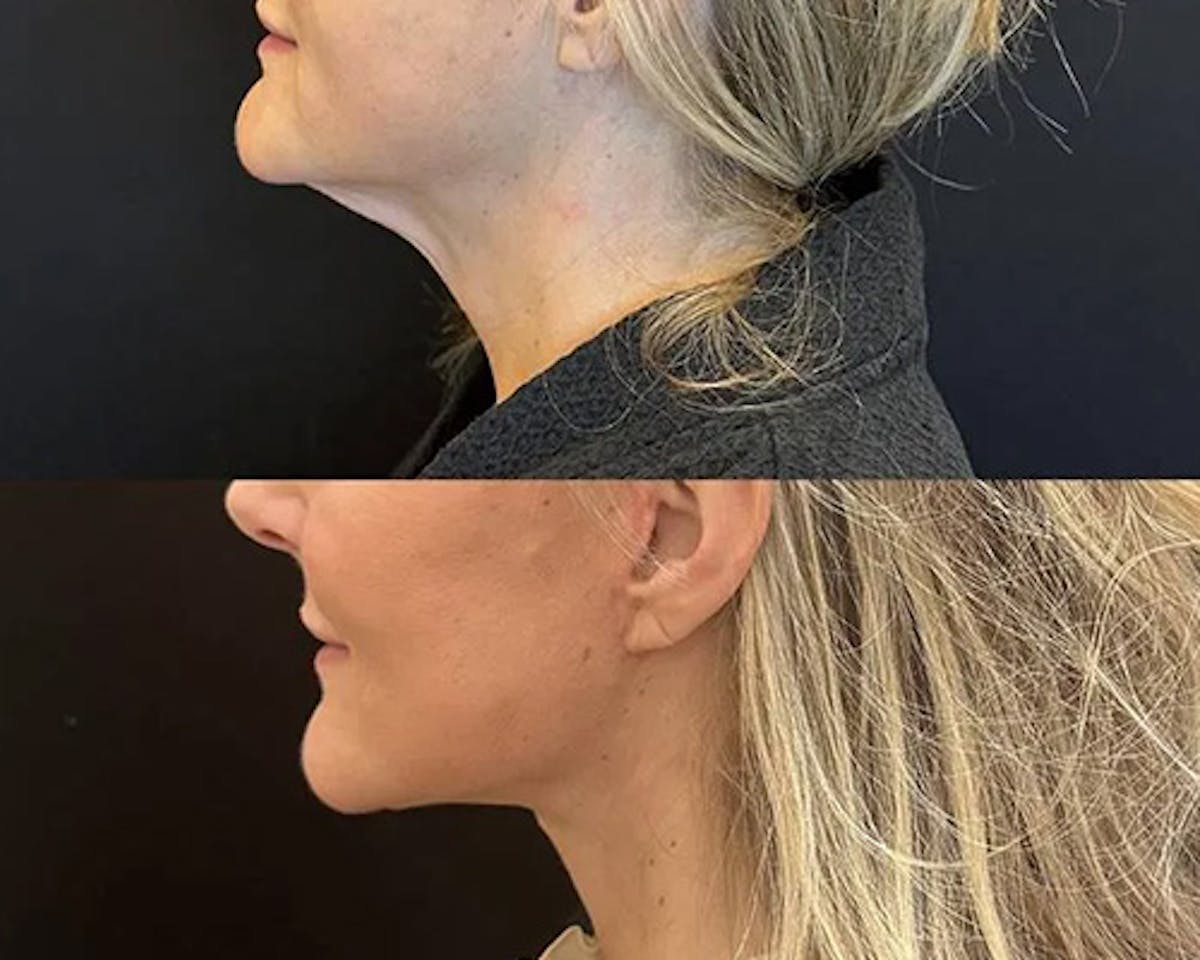 Deep Plane Facelift Before & After Gallery - Patient 689523 - Image 2