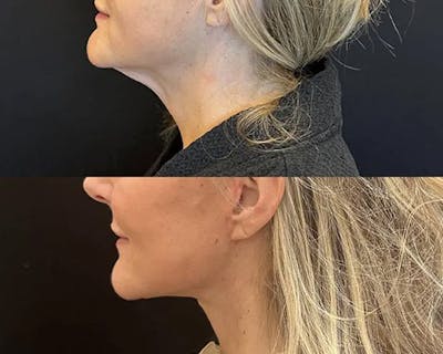 Deep Plane Facelift Before & After Gallery - Patient 689523 - Image 2