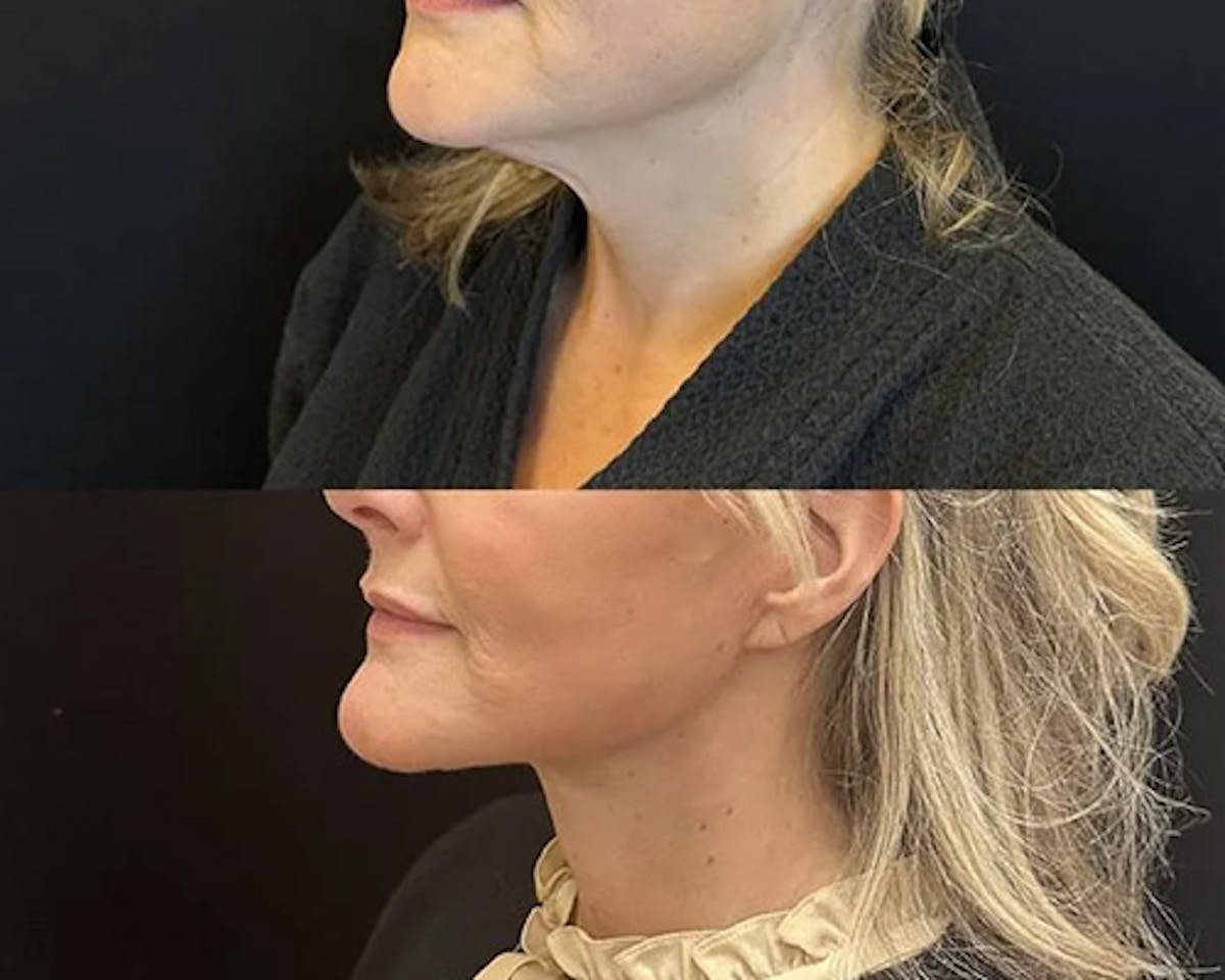 Deep Plane Facelift Before & After Gallery - Patient 689523 - Image 3