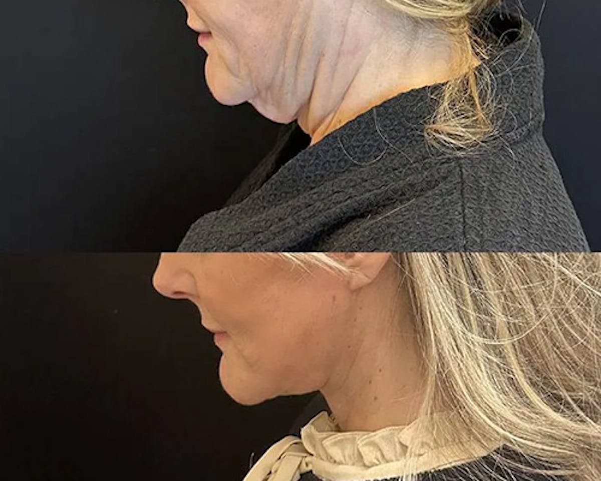 Deep Plane Facelift Before & After Gallery - Patient 689523 - Image 4