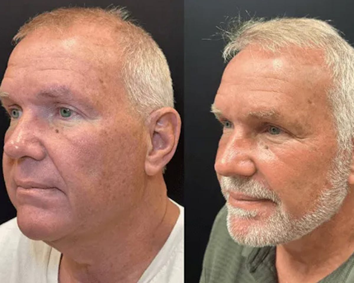 Deep Plane Facelift Before & After Gallery - Patient 417164 - Image 1