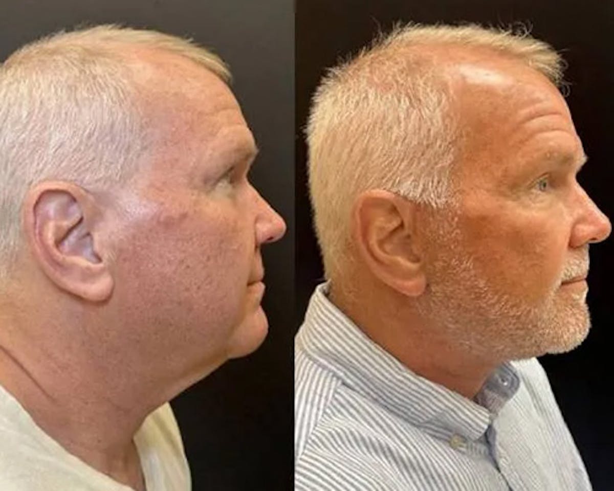 Deep Plane Facelift Before & After Gallery - Patient 417164 - Image 2