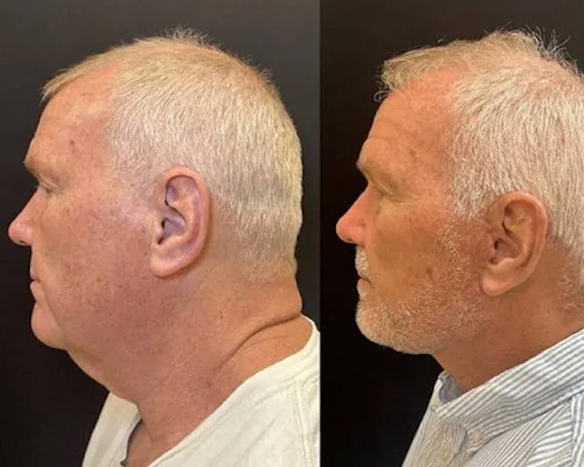 Deep Plane Facelift Before & After Gallery - Patient 417164 - Image 3