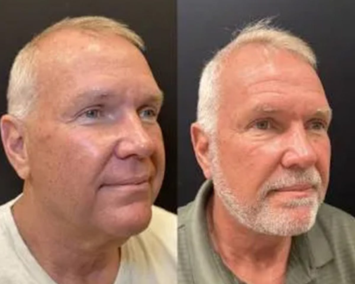 Deep Plane Facelift Before & After Gallery - Patient 417164 - Image 4