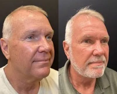 Deep Plane Facelift Before & After Gallery - Patient 417164 - Image 4