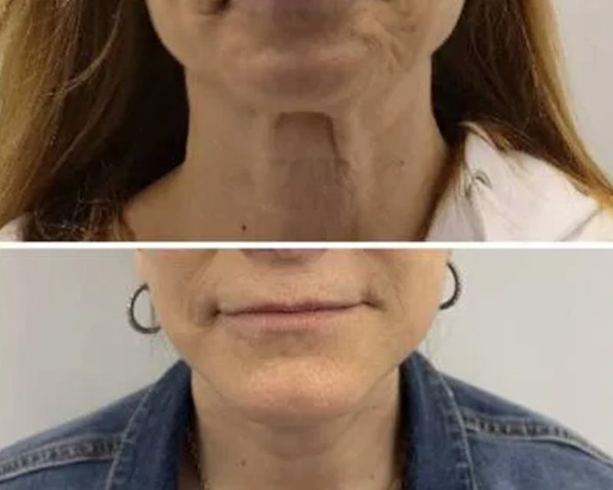 Deep Plane Facelift Before & After Gallery - Patient 699264 - Image 1