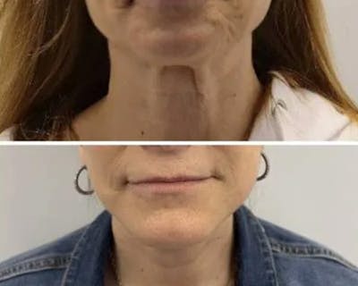 Deep Plane Facelift Before & After Gallery - Patient 699264 - Image 1