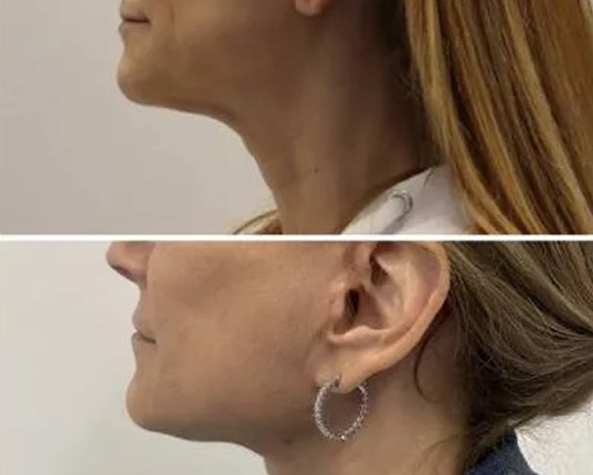 Deep Plane Facelift Before & After Gallery - Patient 699264 - Image 2
