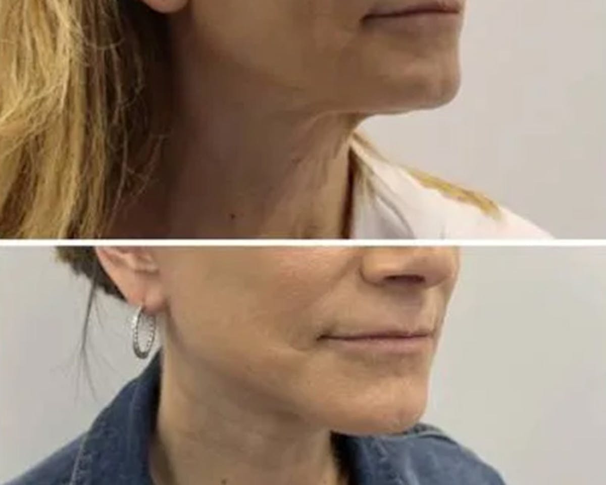 Deep Plane Facelift Before & After Gallery - Patient 699264 - Image 3